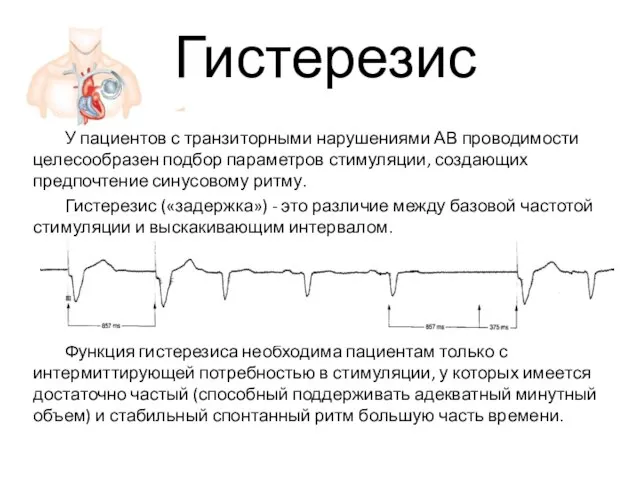 Гистерезис У пациентов с транзиторными нарушениями АВ проводимости целесообразен подбор параметров