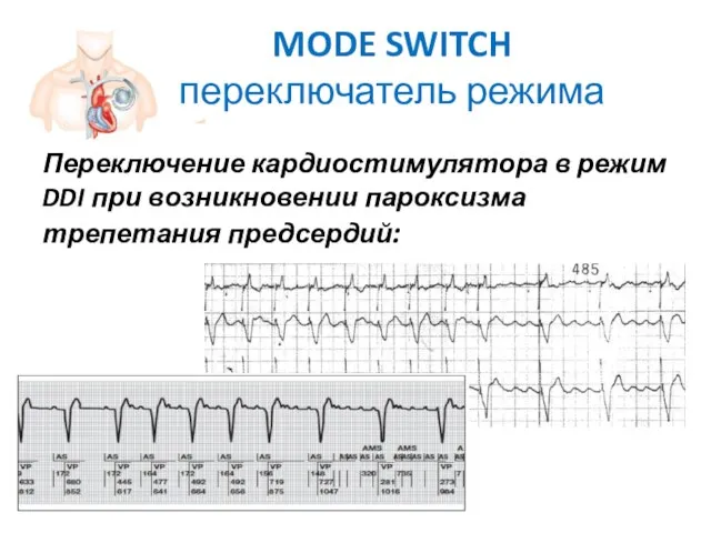 MODE SWITCH переключатель режима Переключение кардиостимулятора в режим DDI при возникновении пароксизма трепетания предсердий: