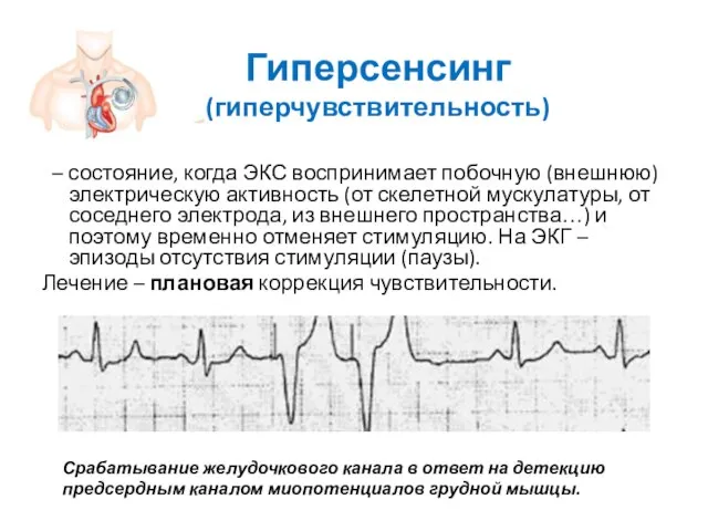 Гиперсенсинг (гиперчувствительность) – состояние, когда ЭКС воспринимает побочную (внешнюю) электрическую активность