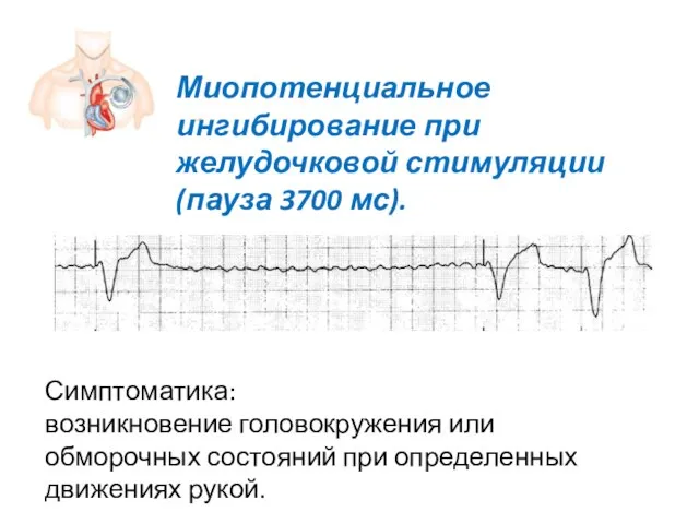 Миопотенциальное ингибирование при желудочковой стимуляции (пауза 3700 мс). Симптоматика: возникновение головокружения