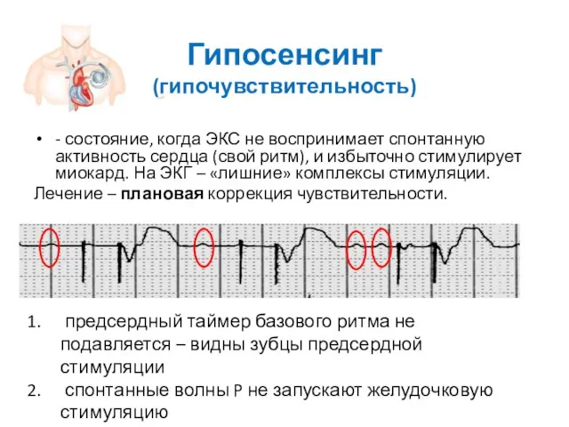 Гипосенсинг (гипочувствительность) - состояние, когда ЭКС не воспринимает спонтанную активность сердца