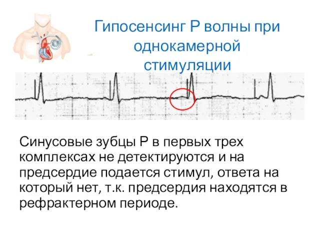 Синусовые зубцы Р в первых трех комплексах не детектируются и на