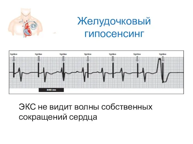 Желудочковый гипосенсинг ЭКС не видит волны собственных сокращений сердца