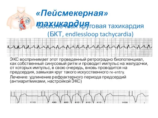 Бесконечная круговая тахикардия (БКТ, endlessloop tachycardia) ЭКС воспринимает этот проведенный ретроградно