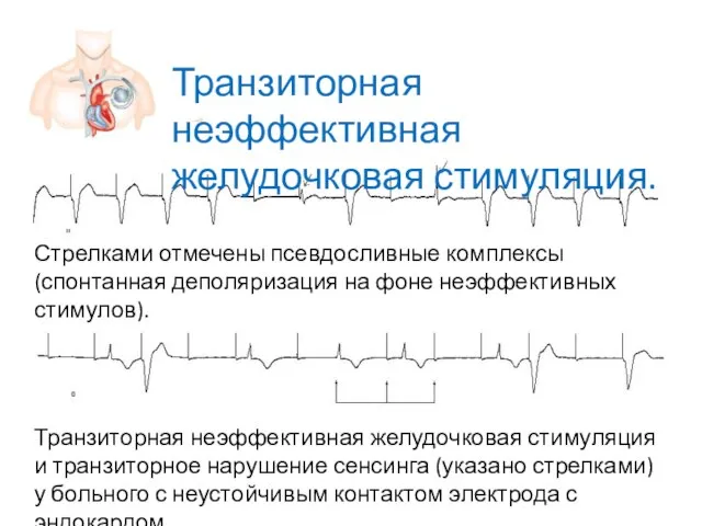 Стрелками отмечены псевдосливные комплексы (спонтанная деполяризация на фоне неэффективных стимулов). Транзиторная