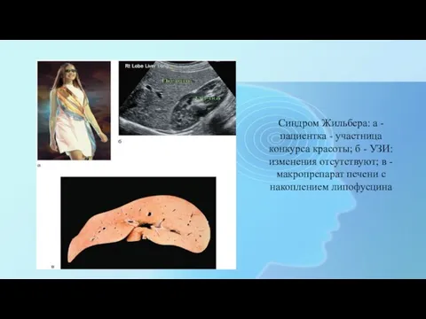 Синдром Жильбера: а - пациентка - участница конкурса красоты; б -