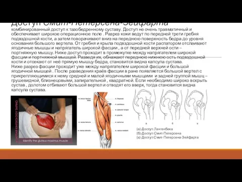 Доступ Смит-Петерсена-Зейфарта комбинированный доступ к тазобедренному суставу. Доступ не очень травматичный