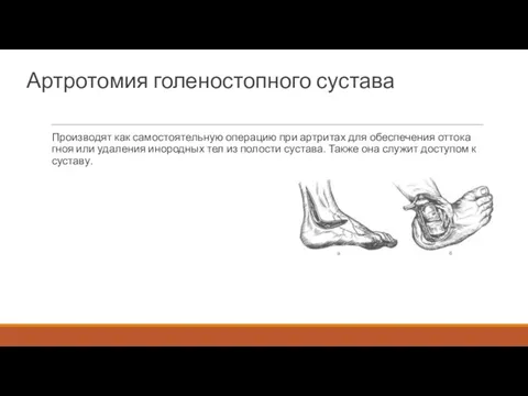 Артротомия голеностопного сустава Производят как самостоятельную операцию при артритах для обеспечения