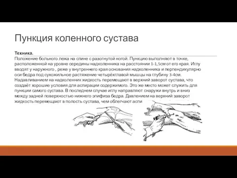 Пункция коленного сустава Техника. Положение больного лежа на спине с разогнутой