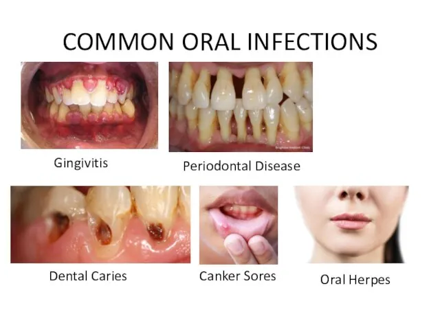 COMMON ORAL INFECTIONS Oral Herpes Gingivitis Periodontal Disease Dental Caries Canker Sores