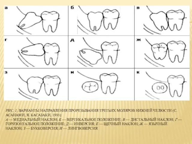 РИС. 1. ВАРИАНТЫ НАПРАВЛЕНИЯ ПРОРЕЗЫВАНИЯ ТРЕТЬИХ МОЛЯРОВ НИЖНЕЙ ЧЕЛЮСТИ (С. АСАНАМИ,