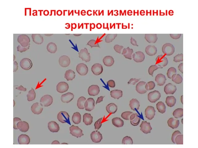 Патологически измененные эритроциты: