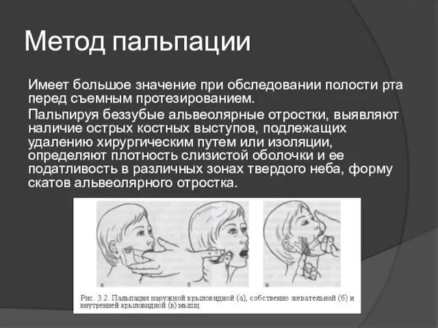 Метод пальпации Имеет большое значение при обследовании полости рта перед съемным