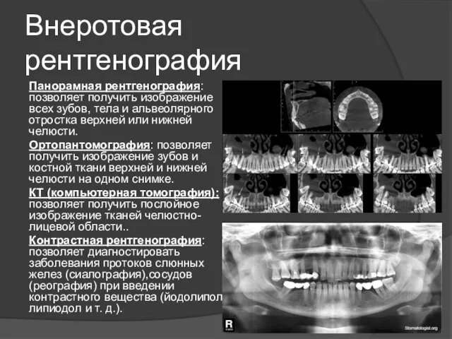 Внеротовая рентгенография Панорамная рентгенография: позволяет получить изображение всех зубов, тела и