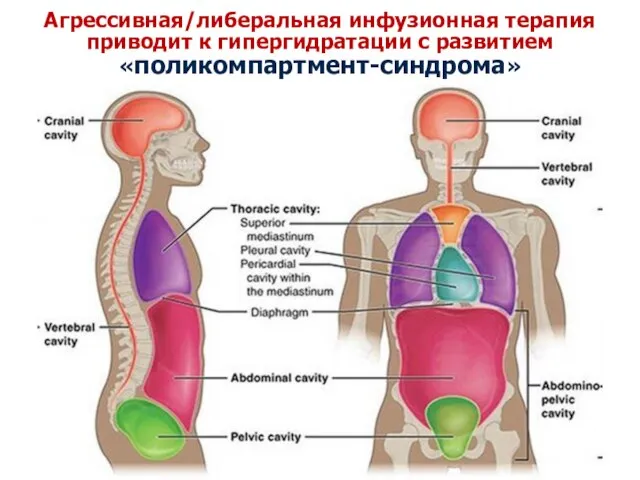 Агрессивная/либеральная инфузионная терапия приводит к гипергидратации с развитием «поликомпартмент-синдрома»