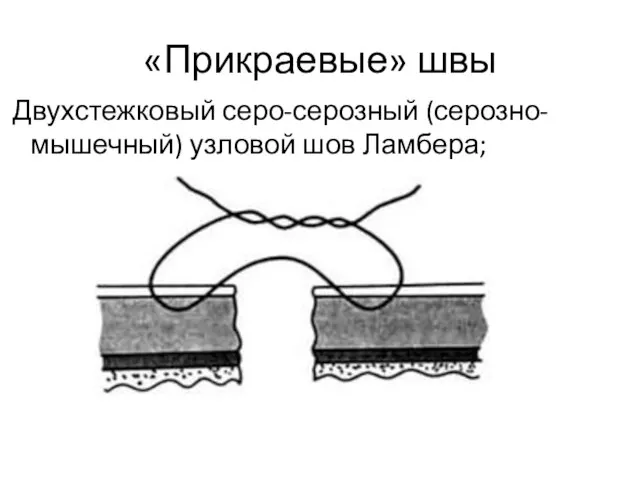 «Прикраевые» швы Двухстежковый серо-серозный (серозно-мышечный) узловой шов Ламбера;