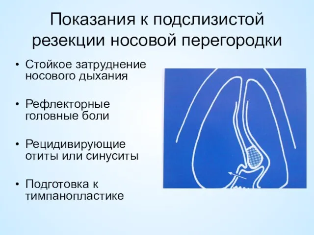 Показания к подслизистой резекции носовой перегородки Стойкое затруднение носового дыхания Рефлекторные