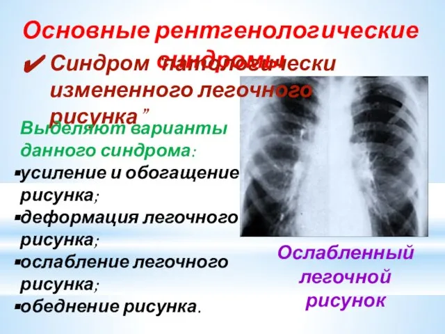 Основные рентгенологические синдромы Ослабленный легочной рисунок Синдром “патологически измененного легочного рисунка”