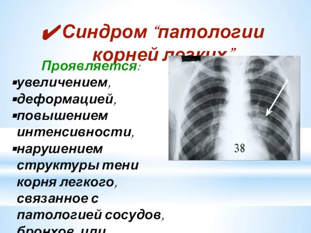 Синдром “патологии корней легких” Проявляется: увеличением, деформацией, повышением интенсивности, нарушением структуры