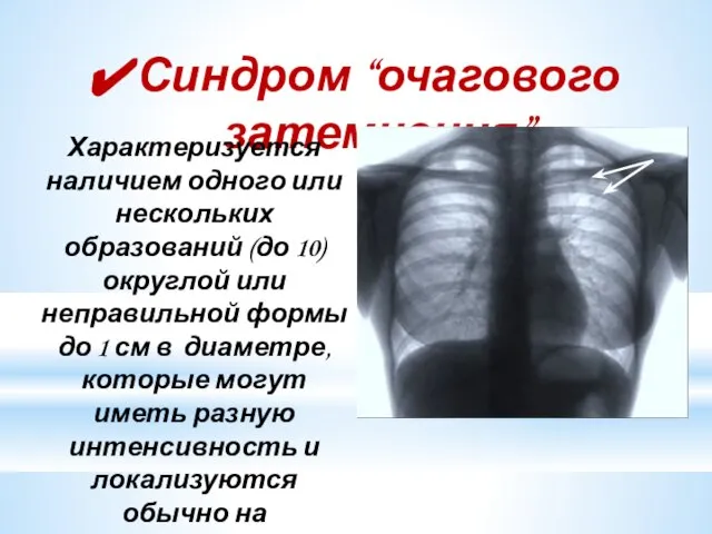 Синдром “очагового затемнения” Характеризуется наличием одного или нескольких образований (до 10)