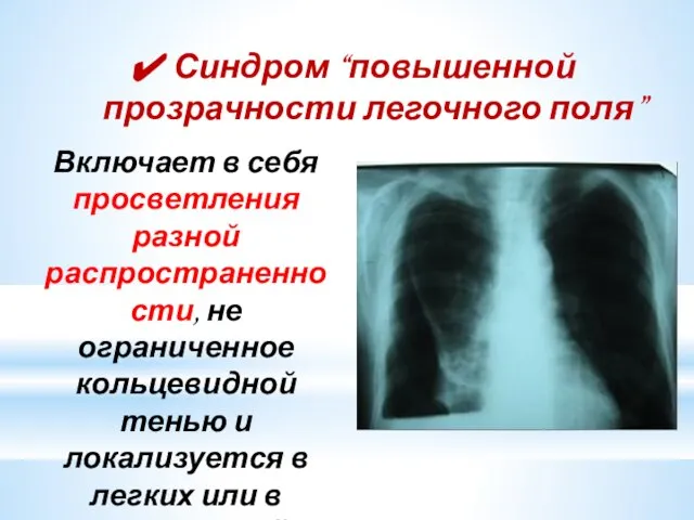 Синдром “повышенной прозрачности легочного поля” Включает в себя просветления разной распространенности,