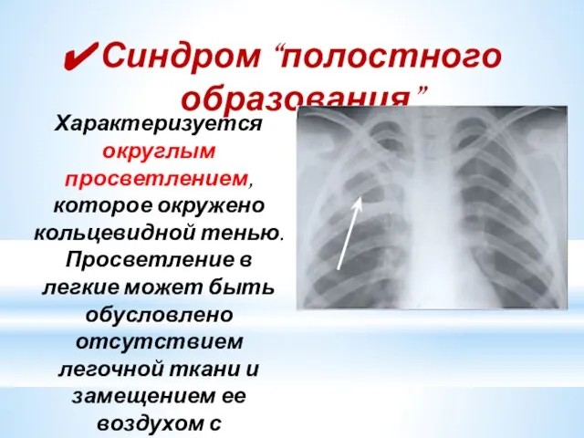 Синдром “полостного образования” Характеризуется округлым просветлением, которое окружено кольцевидной тенью. Просветление