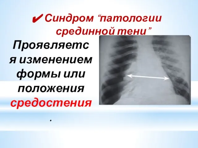 Синдром “патологии срединной тени” Проявляется изменением формы или положения средостения.