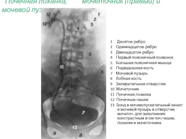 Почечная лоханка, мочеточник (правый) и мочевой пузырь. 1 Десятое ребро 2