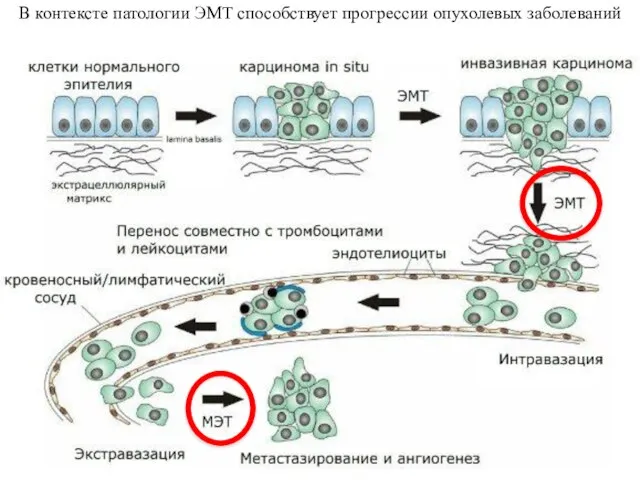 В контексте патологии ЭМТ способствует прогрессии опухолевых заболеваний