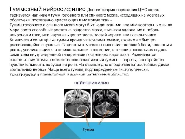 Гуммозный нейросифилис. Данная форма поражения ЦНС харак­теризуется наличием гумм головного или