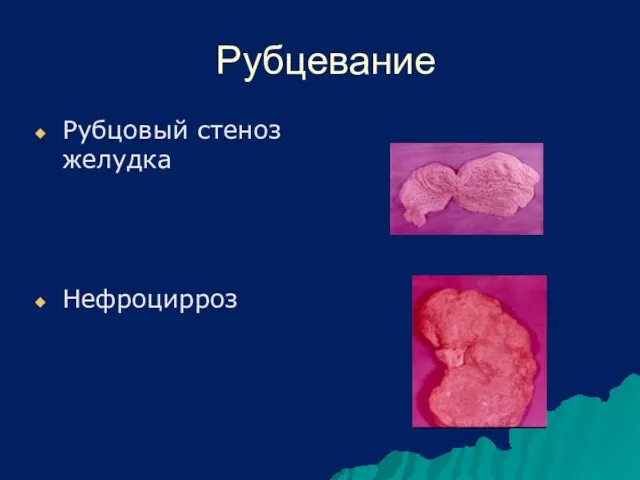 Рубцевание Рубцовый стеноз желудка Нефроцирроз