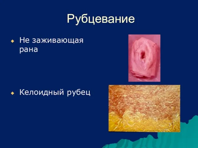 Рубцевание Не заживающая рана Келоидный рубец