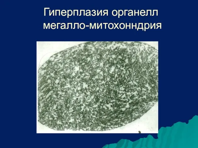 Гиперплазия органелл мегалло-митохонндрия
