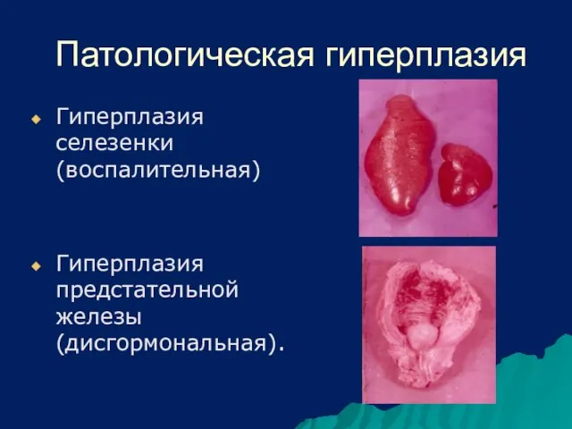 Патологическая гиперплазия Гиперплазия селезенки (воспалительная) Гиперплазия предстательной железы (дисгормональная).