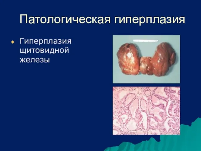 Патологическая гиперплазия Гиперплазия щитовидной железы