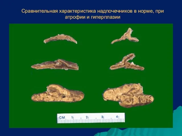 Сравнительная характеристика надпочечников в норме, при атрофии и гиперплазии