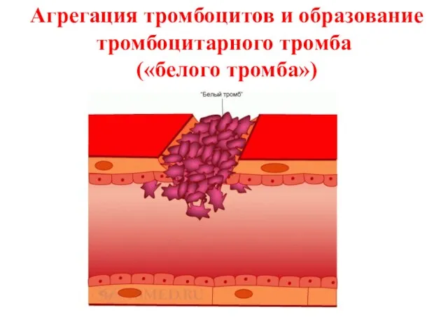 Агрегация тромбоцитов и образование тромбоцитарного тромба («белого тромба»)