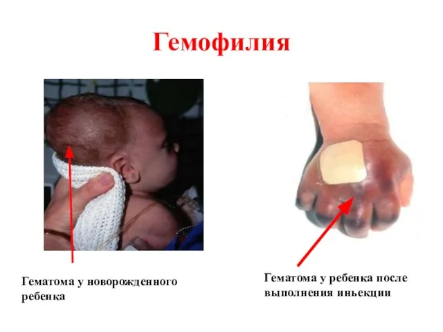 Гемофилия Гематома у новорожденного ребенка Гематома у ребенка после выполнения иньекции