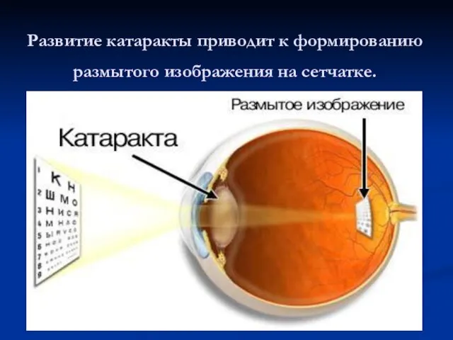 Развитие катаракты приводит к формированию размытого изображения на сетчатке.