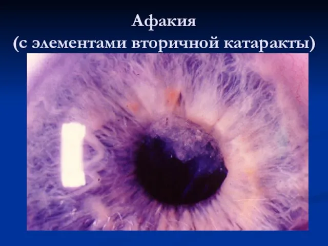 Афакия (с элементами вторичной катаракты)