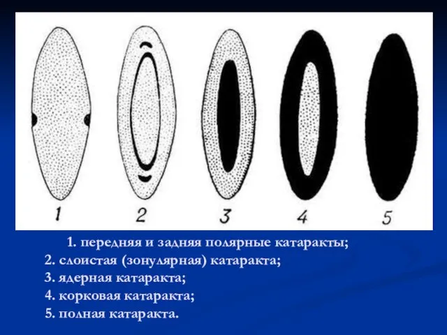 1. передняя и задняя полярные катаракты; 2. слоистая (зонулярная) катаракта; 3.