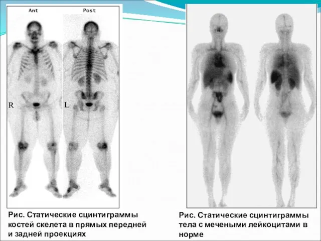 Рис. Статические сцинтиграммы тела с мечеными лейкоцитами в норме Рис. Статические