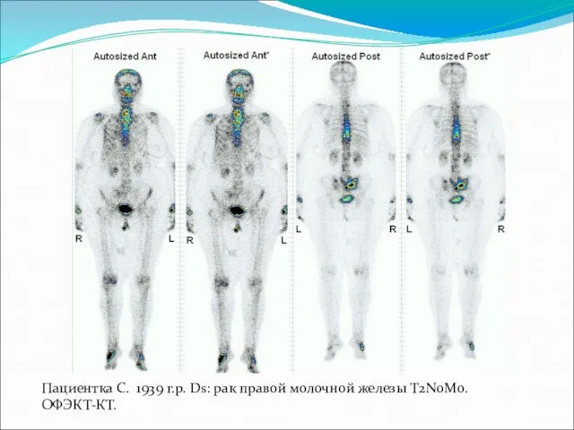 Пациентка С. 1939 г.р. Ds: рак правой молочной железы T2N0M0. ОФЭКТ-КТ.