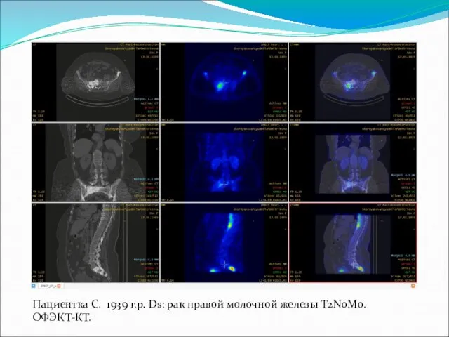 Пациентка С. 1939 г.р. Ds: рак правой молочной железы T2N0M0. ОФЭКТ-КТ.