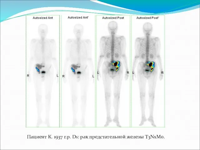 Пациент К. 1937 г.р. Ds: рак предстательной железы T3NxM0.