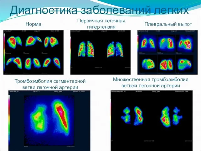 Диагностика заболеваний легких Норма Первичная легочная гипертензия Тромбоэмболия сегментарной ветви легочной