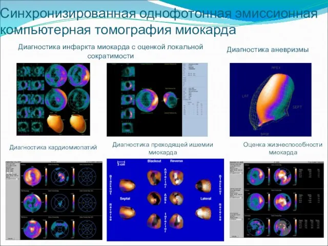 Синхронизированная однофотонная эмиссионная компьютерная томография миокарда Диагностика преходящей ишемии миокарда Диагностика