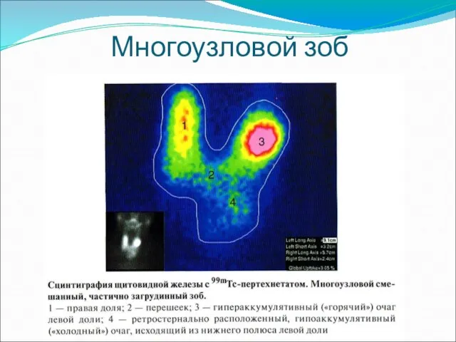 Многоузловой зоб