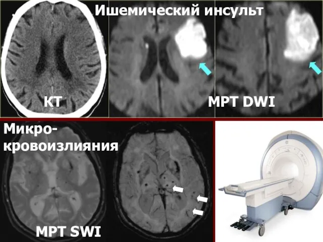 КТ МРТ DWI МРТ SWI Ишемический инсульт Микро-кровоизлияния