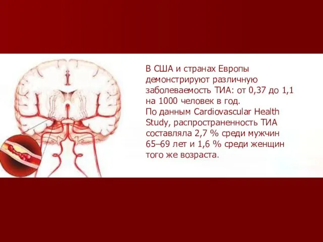 В США и странах Европы демонстрируют различную заболеваемость ТИА: от 0,37